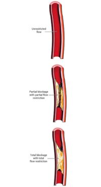 What is Heart Blockage/Blocked Arteries?