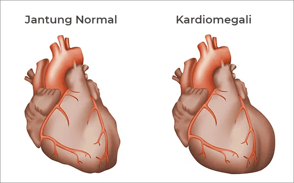 Ilustrasi pemeriksaan jantung bengkak