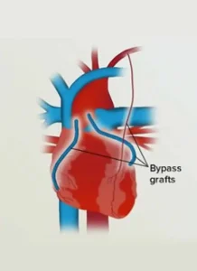 Heart diagram showing coronary artery bypass grafting for treatment of heart artery blockage