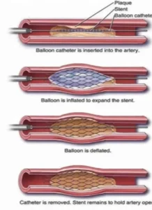 Step-by-step angioplasty and stent procedure showing treatment for heart artery blockage