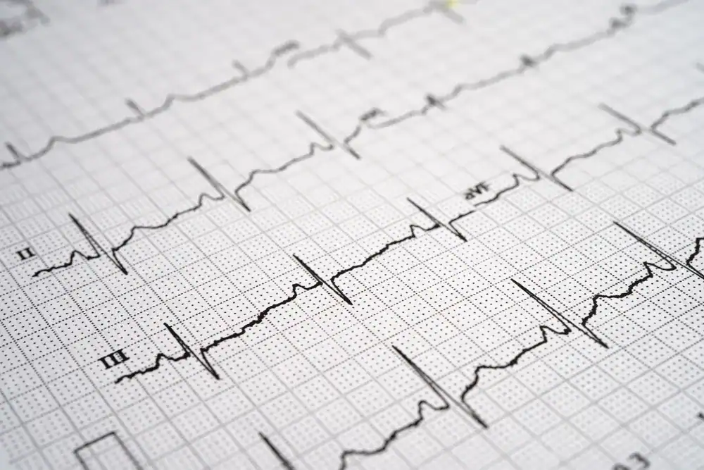 ECG report showing heart rhythm patterns reviewed by a heart specialist in Singapore for cardiac assessment and diagnosis.