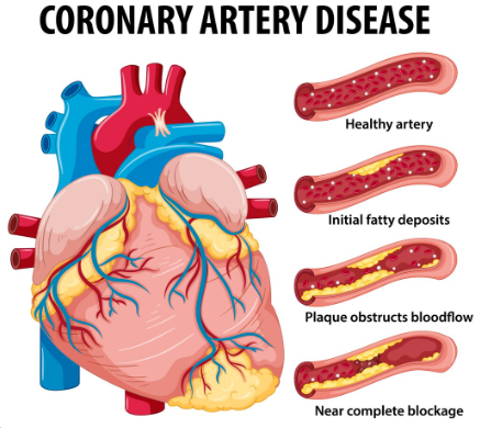 Ilustrasi kondisi penyumbatan pada pembuluh darah arteri