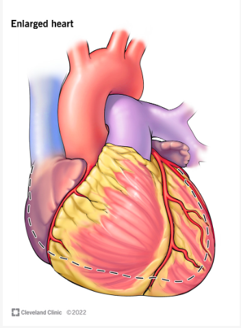 Perbandingan bentuk jantung normal dan jantung bengkak