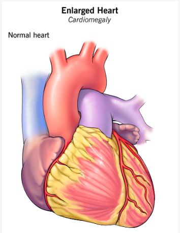 Perbandingan bentuk jantung normal dan jantung bengkak